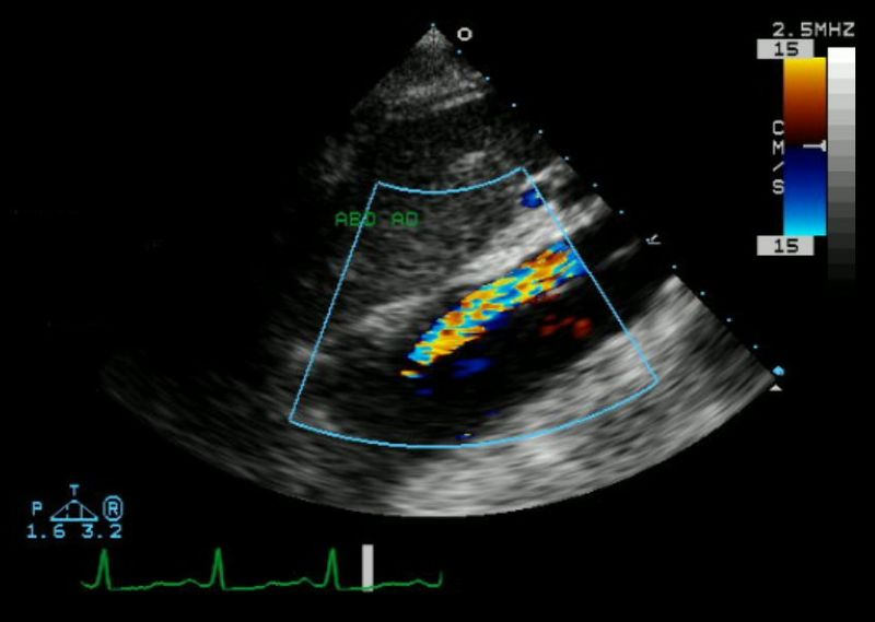 Echocardiogram